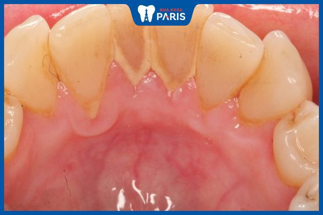 Cao răng hình thành như thế nào? Nguyên nhân và cách phòng ngừa